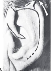 Cartilage grafts 3
