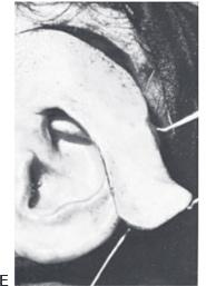 Cartilage grafts 5