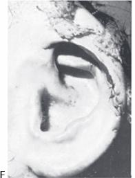 Cartilage grafts 6