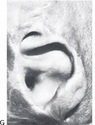 Cartilage grafts 7