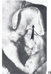 Cartilage grafts 8