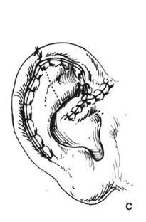 helical3