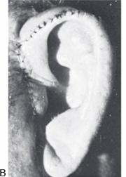 Cartilage grafts 2