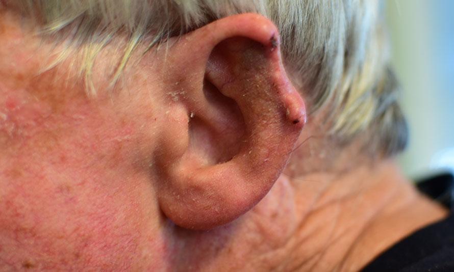 ear amputation