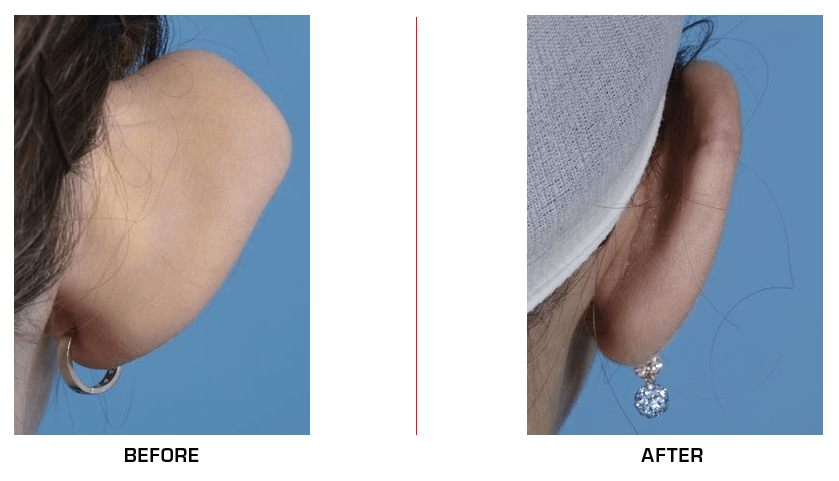 Otoplasty Ear Reduction before after case2