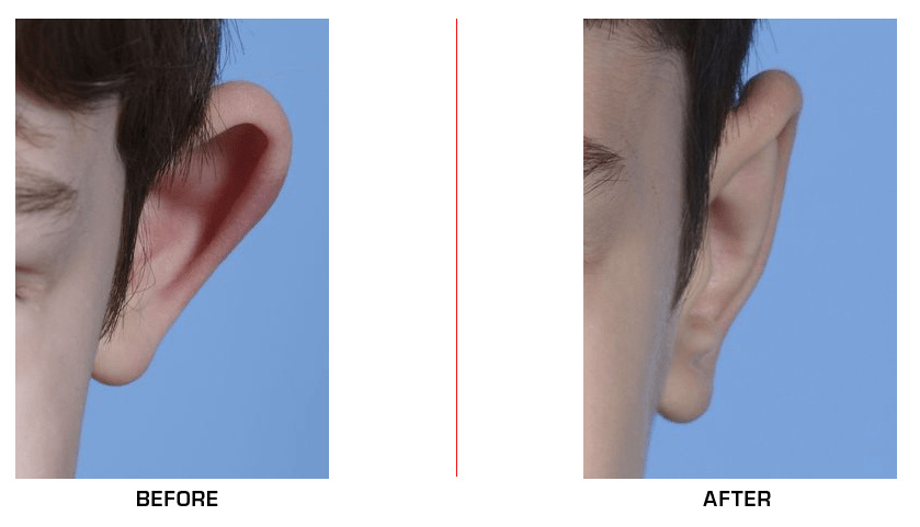 otoplasty before after case4