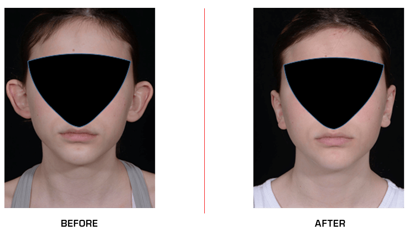 otoplasty before after case6