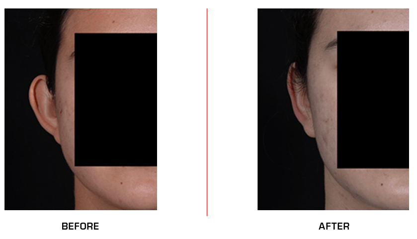 otoplasty before after case7