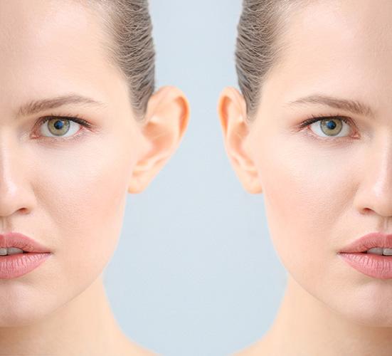 otoplasty reduction