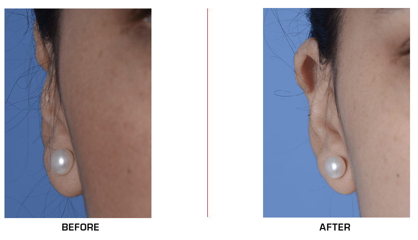 otoplasty revision before after case 1