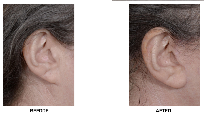 otoplasty revision before after case 1